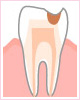 C2 象牙質の虫歯