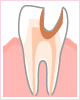 C3 神経に達した虫歯
