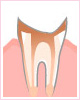 C4 歯冠部が冒された虫歯